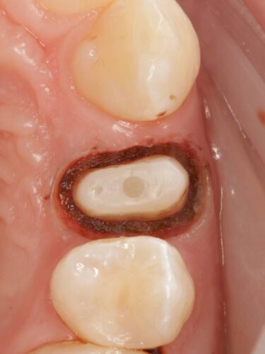 Протезирование зуба в концепции BOPT диоксидом циркония