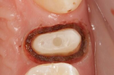 Протезирование зуба в концепции BOPT диоксидом циркония