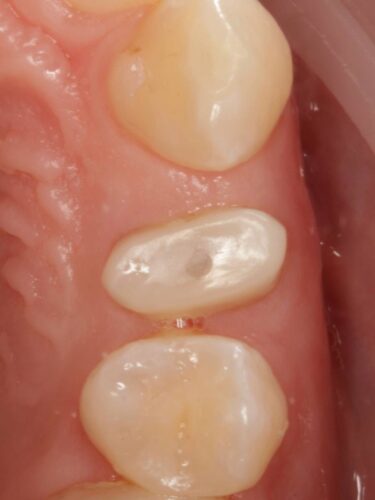 Протезирование зуба в концепции BOPT диоксидом циркония