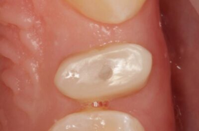 Протезирование зуба в концепции BOPT диоксидом циркония