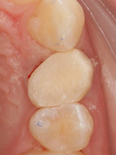 Протезирование зуба в концепции BOPT диоксидом циркония