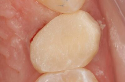 Протезирование зуба в концепции BOPT диоксидом циркония