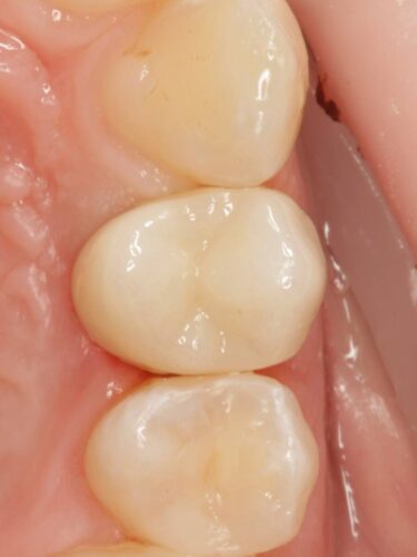 Протезирование зуба в концепции BOPT диоксидом циркония