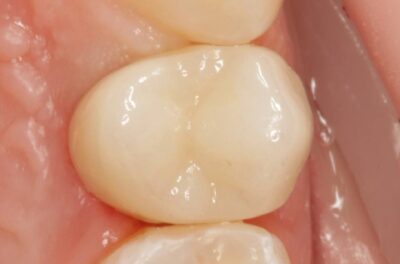 Протезирование зуба в концепции BOPT диоксидом циркония