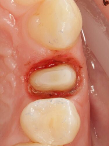 Протезирование зуба в концепции BOPT диоксидом циркония
