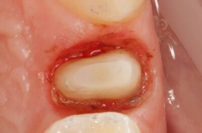 Протезирование зуба в концепции BOPT диоксидом циркония