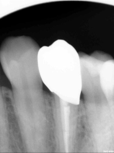 Протезирование зуба в концепции BOPT диоксидом циркония