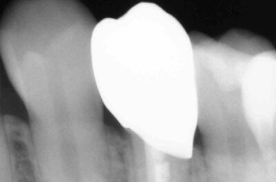 Протезирование зуба в концепции BOPT диоксидом циркония