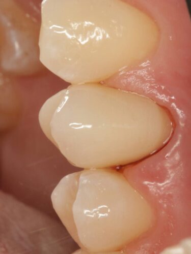 Протезирование зуба в концепции BOPT диоксидом циркония