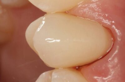 Протезирование зуба в концепции BOPT диоксидом циркония