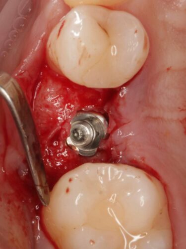 Установка импланта, подшит трансплантат с бугра( для увеличения объема мягких тканей), установлен формирователь десны