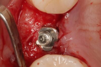 Установка импланта, подшит трансплантат с бугра( для увеличения объема мягких тканей), установлен формирователь десны