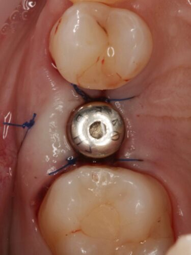 Установка импланта