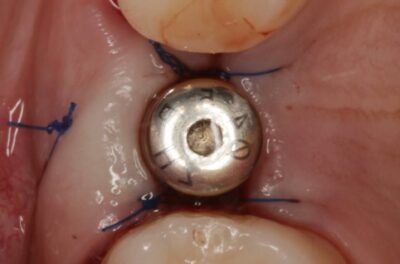 Установка импланта