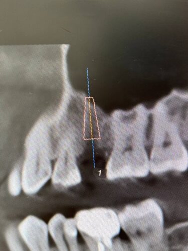 Установка импланта, подшит трансплантат с бугра( для увеличения объема мягких тканей), установлен формирователь десны