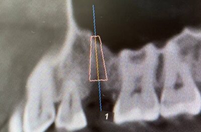 Установка импланта, подшит трансплантат с бугра( для увеличения объема мягких тканей), установлен формирователь десны