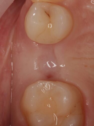 Установка импланта, подшит трансплантат с бугра( для увеличения объема мягких тканей), установлен формирователь десны