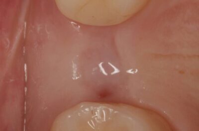 Установка импланта, подшит трансплантат с бугра( для увеличения объема мягких тканей), установлен формирователь десны