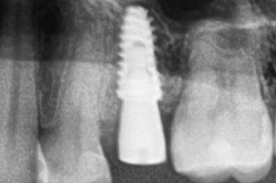 Установка импланта, подшит трансплантат с бугра( для увеличения объема мягких тканей), установлен формирователь десны