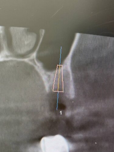 Установка импланта, подшит трансплантат с бугра( для увеличения объема мягких тканей), установлен формирователь десны