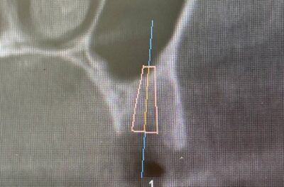 Установка импланта, подшит трансплантат с бугра( для увеличения объема мягких тканей), установлен формирователь десны