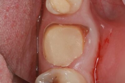 Одномоментная имплантация