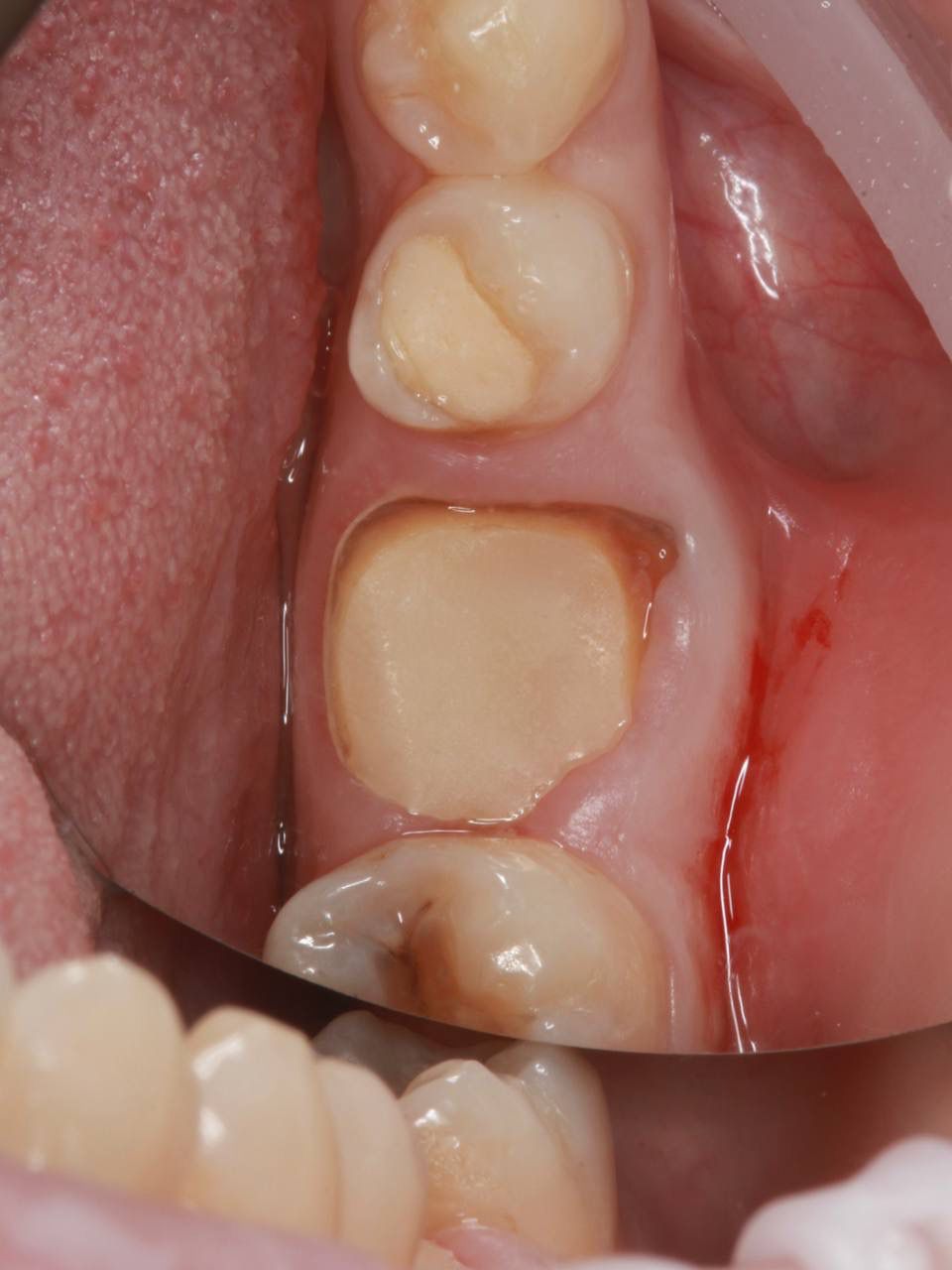 Одномоментная имплантация