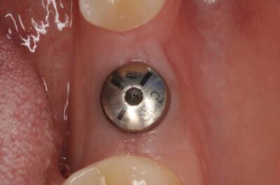 Одномоментная имплантация