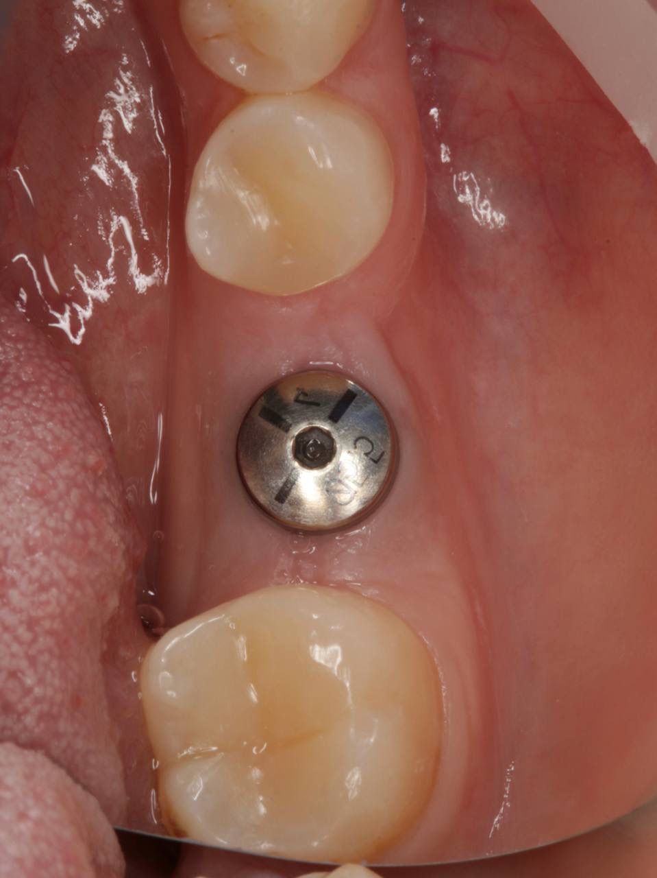 Одномоментная имплантация