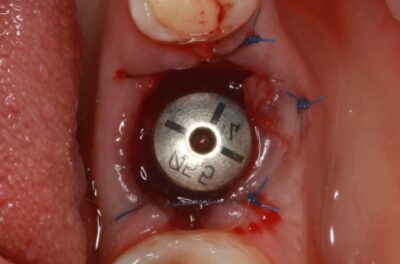 Одномоментная имплантация