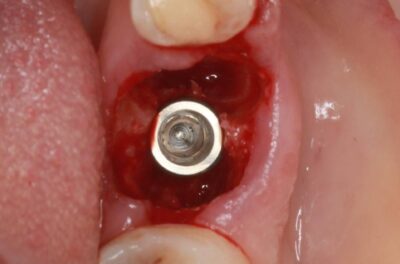 Одномоментная имплантация