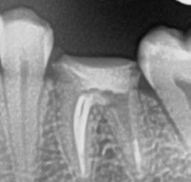 Одномоментная имплантация