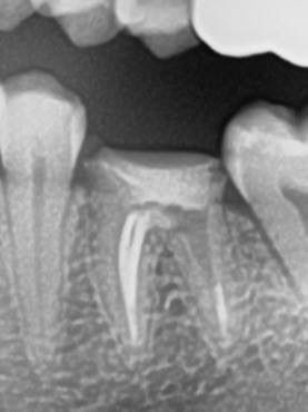 Одномоментная имплантация