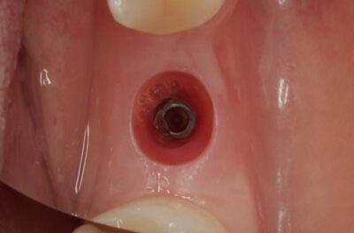 Одномоментная имплантация