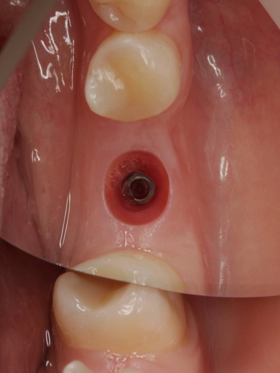 Одномоментная имплантация