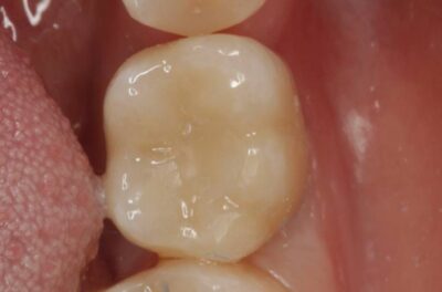 Одномоментная имплантация