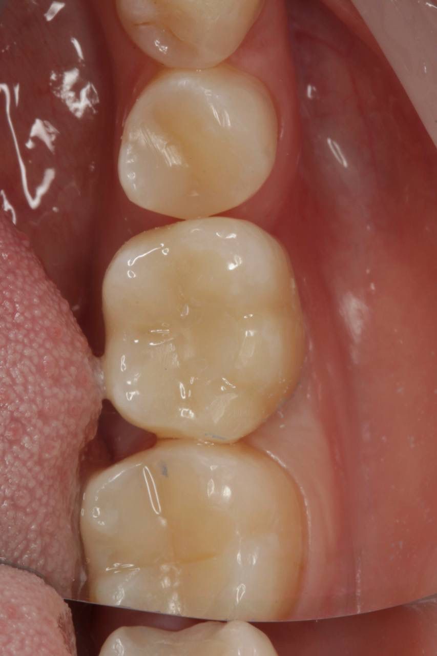 Одномоментная имплантация