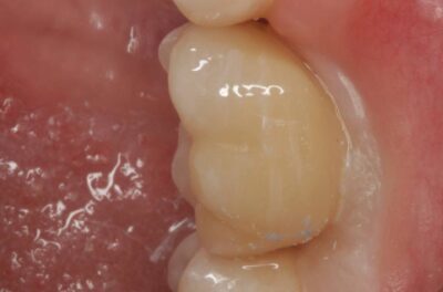 Одномоментная имплантация