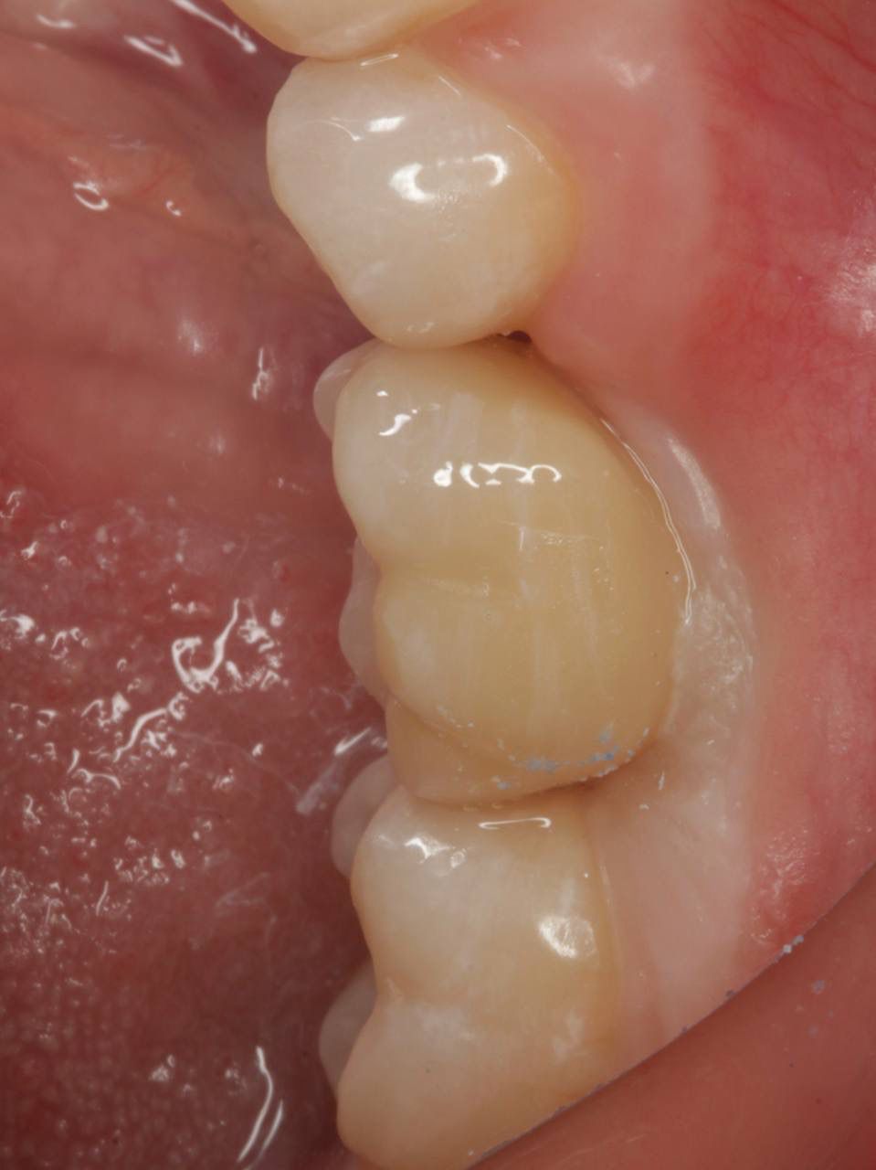 Одномоментная имплантация