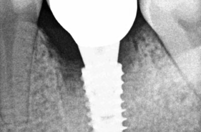 Одномоментная имплантация