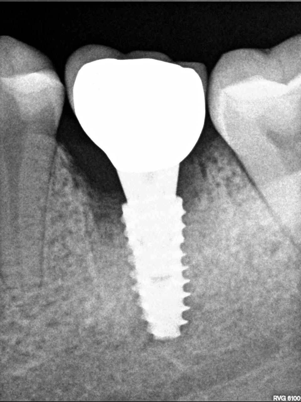 Одномоментная имплантация