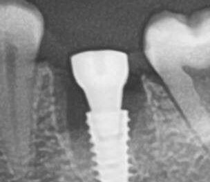 Одномоментная имплантация