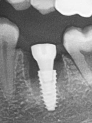 Одномоментная имплантация