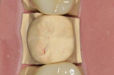 Изображение - Протезирование коронками из диоксида циркония