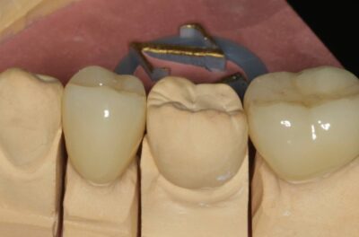 Изображение - Протезирование коронками из диоксида циркония