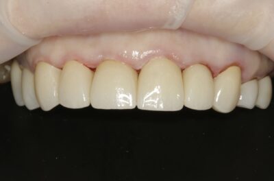 Изображение - Протезирование коронками из диоксида циркония