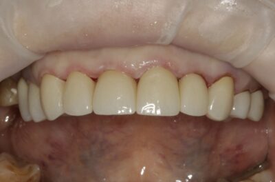 Изображение - Протезирование коронками из диоксида циркония