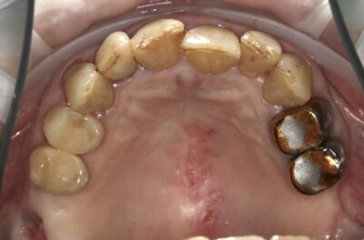 Изображение - Протезирование коронками из диоксида циркония