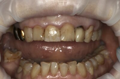 Изображение - Протезирование коронками из диоксида циркония