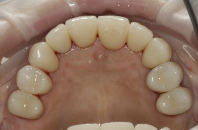 Изображение - Протезирование коронками из диоксида циркония